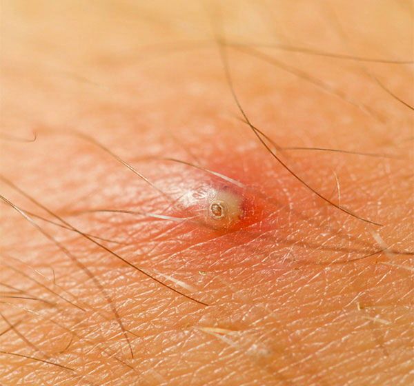 Ingrown Hair Treatments | Avenue Advanced Skin Care