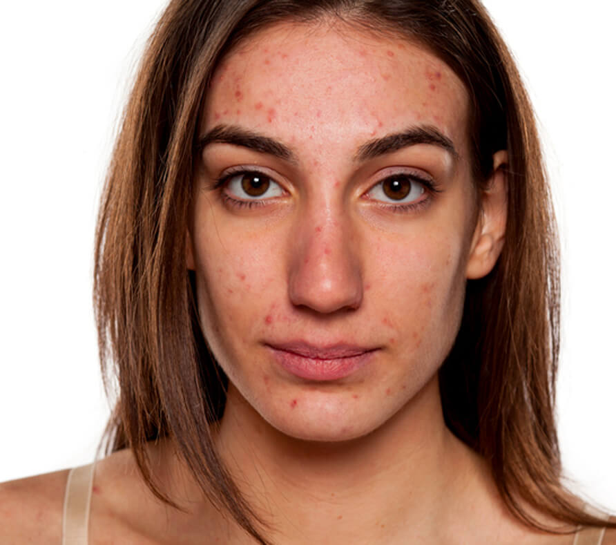 Acne Treatment Melbourne | Acne Clinic Melbourne | AASC