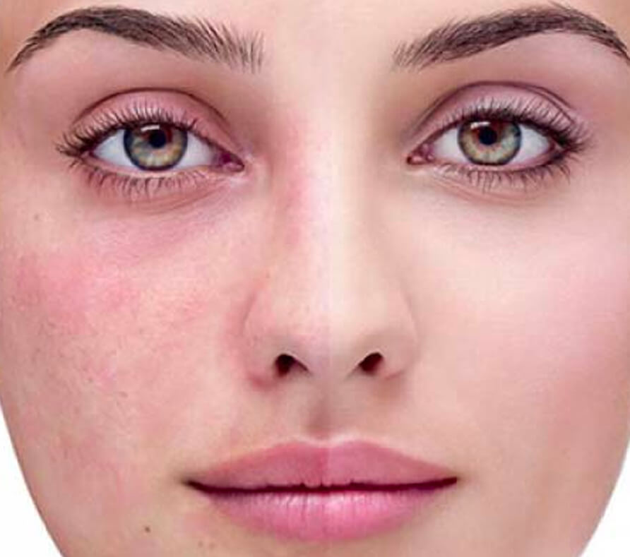 Rosacea Treatments Melbourne Laser Therapy For Facial Redness Aasc