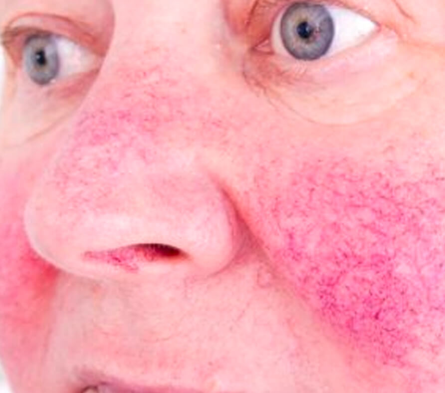 Rhinophyma DermNet
