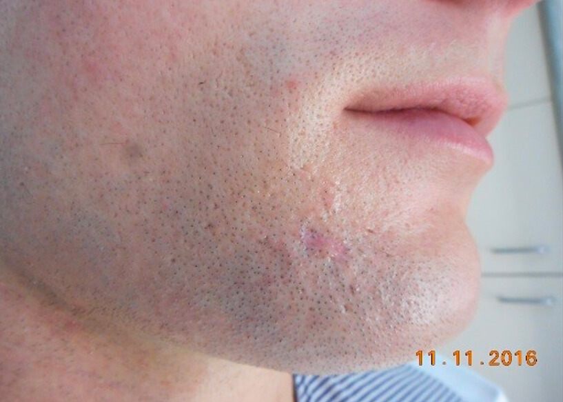 Scar Removal Treatments Melbourne | Repair Facial Scarring | AASC