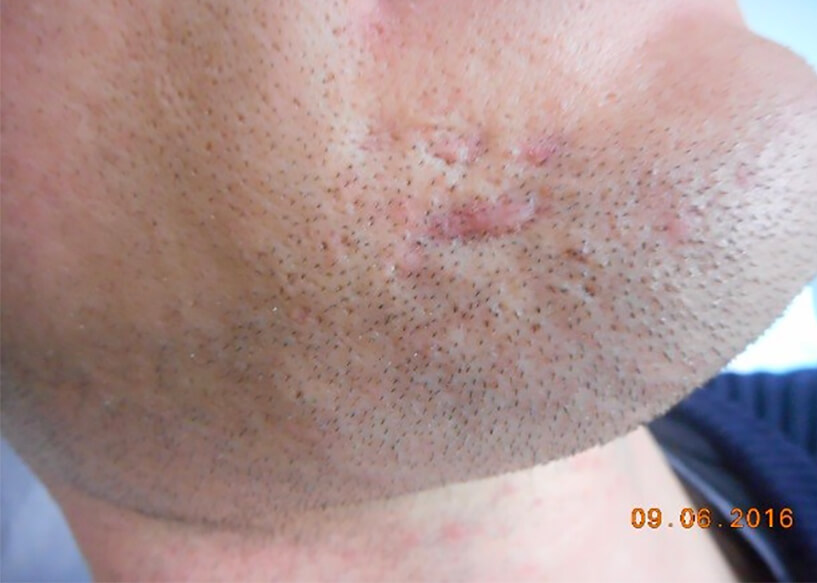 Scar Removal Treatments Melbourne Repair Facial Scarring AASC