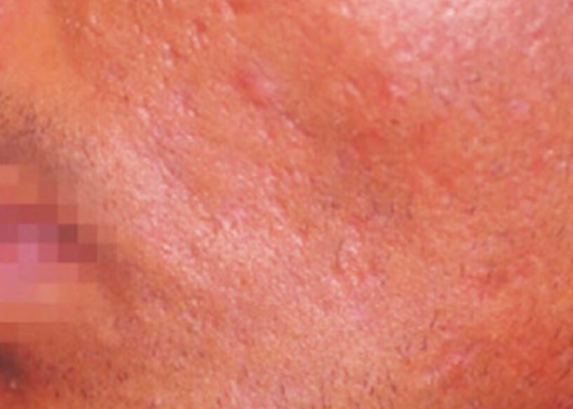 Scar Removal Treatments Melbourne Repair Facial Scarring AASC