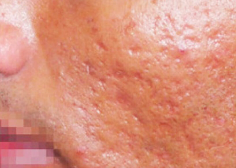 Scar Removal Treatments Melbourne Repair Facial Scarring AASC