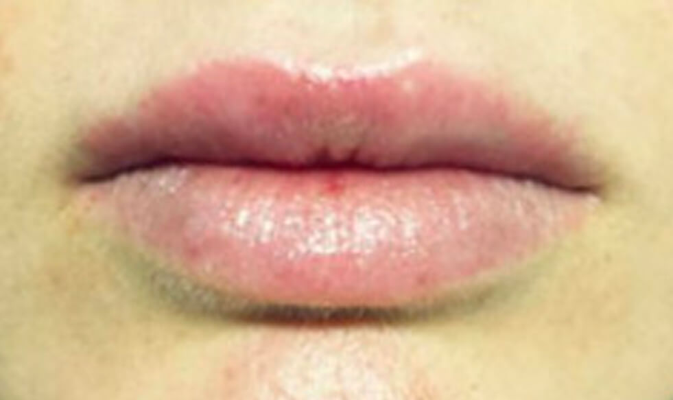 Lip Augmentation Melbourne Fat Transfer To Lips Aasc 2480