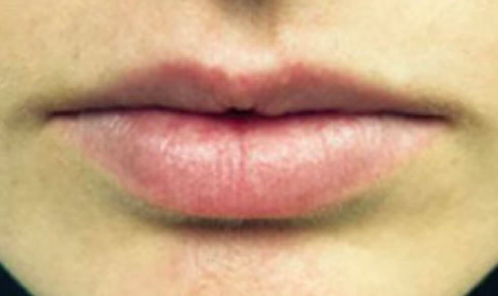 Lip Augmentation Melbourne Avenue Advanced Skin Care