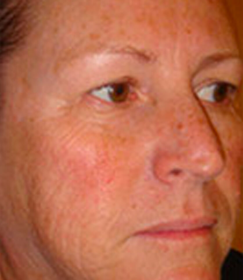 Dermasweep Microdermabrasion Melbourne Avenue Advanced Skin Care